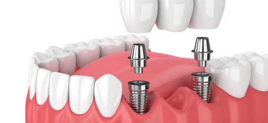 Dental Implants